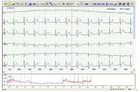 24 órás EKG monitorozás