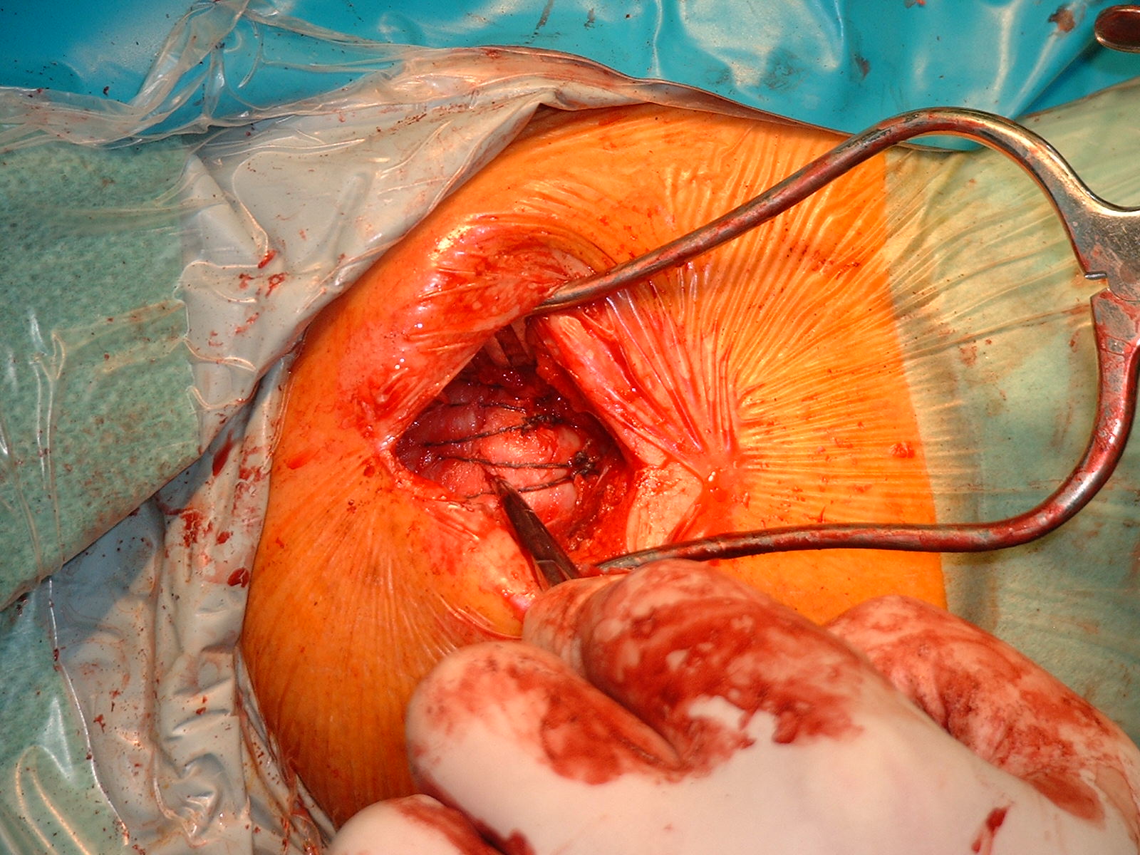 Betegtájékoztató – Váll rotátorköpeny műtétről