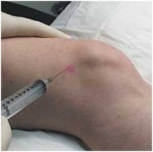 hialuronsav injekció után artrózis lábízületi kezelés